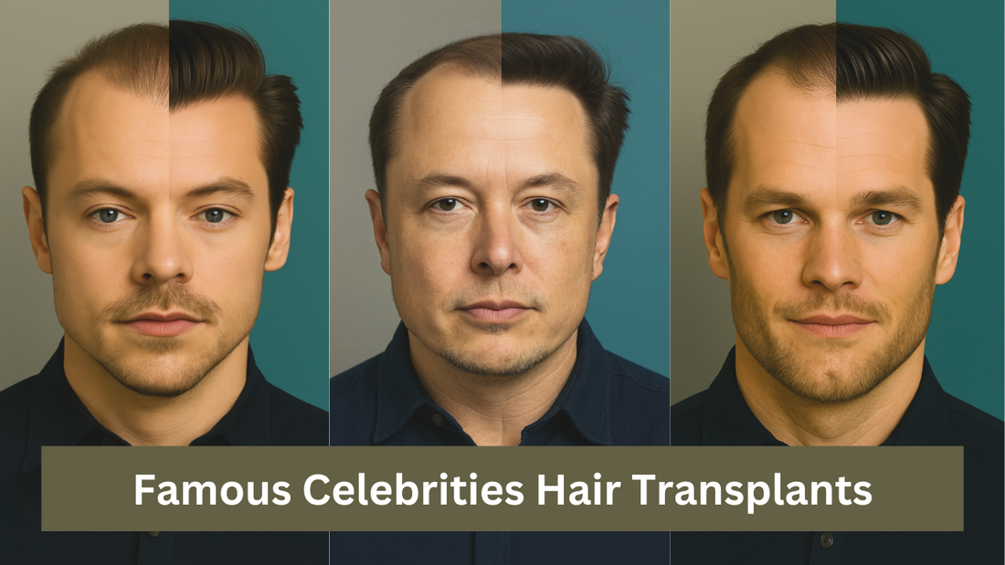 Celebrity Hair Transplants Before and After