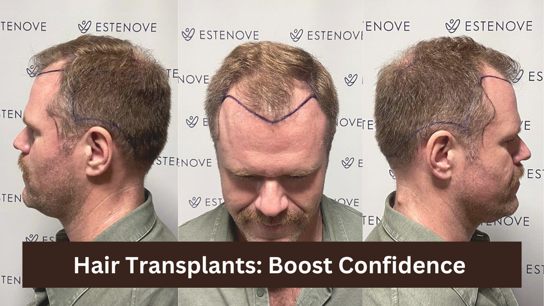 Hair Transplants for Men