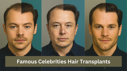 Celebrity Hair Transplants Before and After