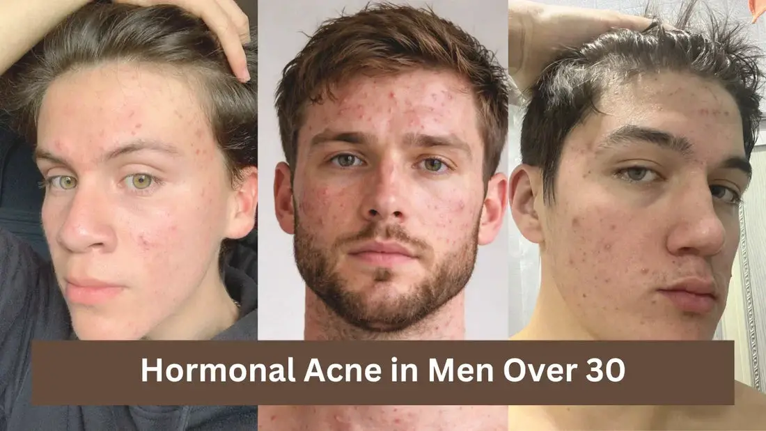 Hormonal Acne in Men Over 30